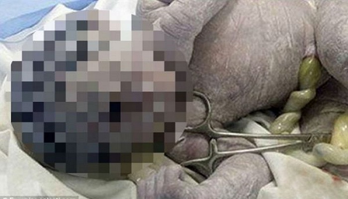 Μωρό κύκλωπας γεννήθηκε στην Αίγυπτο – Σοκαριστική φωτογραφία!